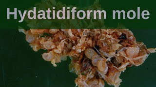 Complete Hydatidiform Mole  Pathology mini tutorial [upl. by Namzaj]