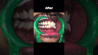 Amazing results of smile makeover treatment [upl. by Siseneg]