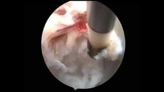 anular tear and repair [upl. by Naloc]