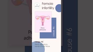 Female Infertility Cause 6 Pelvic adhesions bands of scar tissue [upl. by Denten]