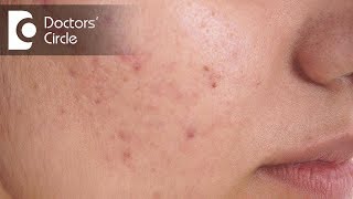 How does Microdermabrasion work for active Acne  Dr Shreeshail Kumbar [upl. by Ecila]