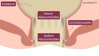 Was sind Hämorrhoiden [upl. by Freedman733]