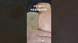 리팟 레이저 다발성 흑자 세종리팟 세종시리팟 reepot lentigo multiplelentigo 청주리팟 공주리팟 대전리팟 오창리팟 오송리팟 부여리팟 [upl. by Mesics]