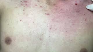 ACNE TREATMENT VU QUYNH MI Acne On Boys Chest 2024 [upl. by Gnol]