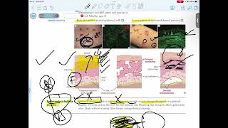 EPIDERMOLYSIS BULLOSA SIMPLEX [upl. by Ocnarf]