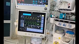 Ventilator in monitor ECG SPO2  ETCO2 [upl. by Kaia883]