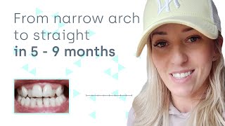 How clear aligners can expand a narrow dental arch at home [upl. by Eslehc]