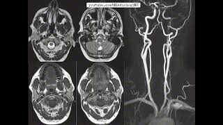 Case 98 with Horners syndrome [upl. by Warram]