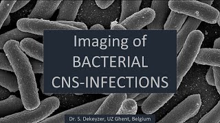 Imaging of bacterial pyogenic brain infections [upl. by Mairem]