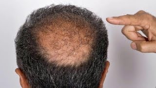 CURE BALDNESS And HOW TO REGROW HAIR NATURALLY without Transplant Surgery [upl. by Sigvard]