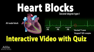 Heart AV Blocks  INTERACTIVE Animation with Quiz [upl. by Frey]