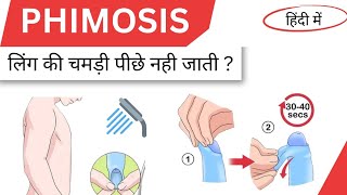 Phimosis causes symptoms and treatment in hindi [upl. by Spragens]