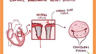 Chronic Rheumatic Heart Disease [upl. by Flatto]