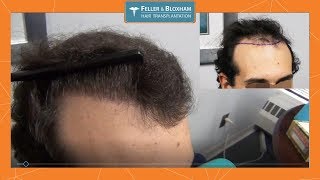 Young Hair Transplant Results  3000 Graft Hair Transplant  Feller amp Bloxham  NY NYC [upl. by Jacquenette]