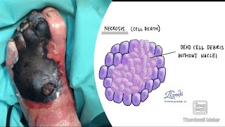 Necrosis and its types coagulative liquefactive caseous fat fibrinoid necrosis fmge neetpg [upl. by Ogaitnas485]