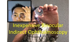 Inexpensive Binocular Indirect Ophthalmoscopy Technique with 30 lens Without BIO headset [upl. by Ahsile291]