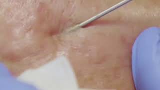 Acne Scar Treatment at Dr Johars Plastic Surgery Group acne scar treatment [upl. by Anallese445]