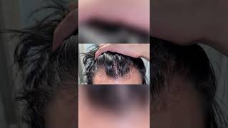 Finasteride results finasteride hairlosstreatment hair hairlosscure hairloss [upl. by Redlac]