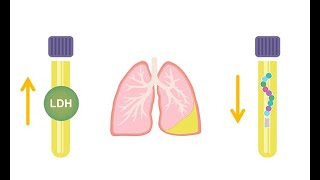 Differentiating transudative and exudative effusions transudate vs exudate [upl. by Arreyt]