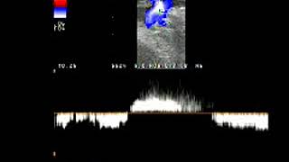 Doppler Venous reflux saphenofemoral junction reflux [upl. by Ocimad]