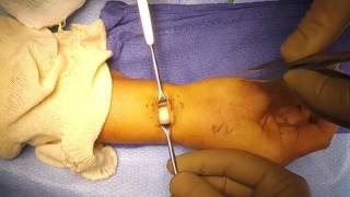 First Extensor Compartment Release for deQuervains Tenosynovitis [upl. by Modeerf]