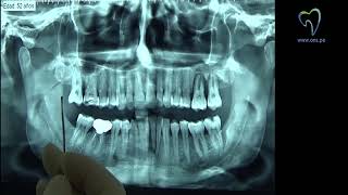 Cómo leer una radiografía panorámica [upl. by Novihs]