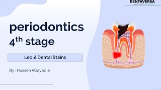 Periodontics Stage4 Lec 6 Dental Stains  DentaVersa Academy  دنتافيرسا اكادمي [upl. by Hsepid]