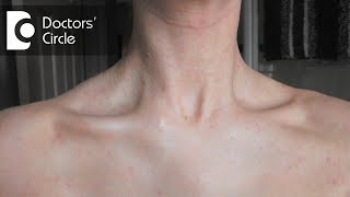 What causes a sudden red rash around the neck in women  Dr Aruna Prasad [upl. by Meredithe287]