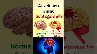 Anzeichen eines Schlaganfalls [upl. by Anan]