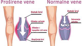 ODABERI ZDRAVLJE  PROBLEMI S VENAMA [upl. by Alleen540]