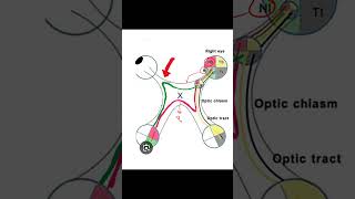 Junctional Scotoma insightophthalmology visual field ophthalmology [upl. by Annahgiel894]