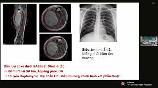 CA LÂM SÀNG NHIỄM TRÙNG MRSA DAI DẲNG [upl. by Mattox]