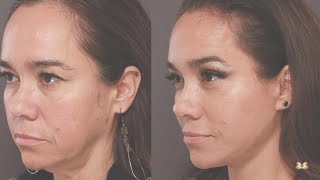 Facelift Patient’s Surgery Journey  Utah Facial Surgeons Patient Journey from start to finish [upl. by Goat]