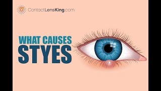 What Are Styes Causes Symptoms and Treatments [upl. by Dimitri]