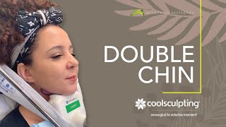 Double Chin Coolsculpting [upl. by Ennaeel57]