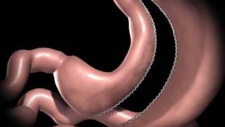 Gastric Sleeve Procedure [upl. by Durrace]