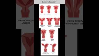 uterine anomalies  arcuate uterus septate uterus unicornuate uterus  bicornuate uterus  uterus [upl. by Buchheim]