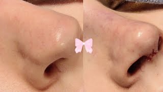 baby boop 💉🎀 𝜗𝜚 transforming bulbous tip into thin amp small ✧ ‧₊˚ 🐇 [upl. by Onavlis]