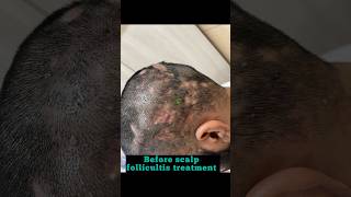 Scalp follicultis treatment drashimagoel skincare parisaskinclinic dermatologistinchandigarh [upl. by Trillby]