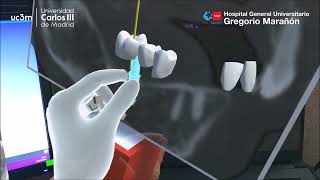 Augmented Reality application on Microsoft HoloLens 2 for Planning Dental Implants Placement [upl. by Nevar937]