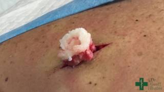 Removal of an Epidermal cyst on the upper back [upl. by Lenzi]