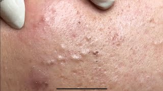 ACNE TREATMENT VU QUYNH MI  Perennial Blackheads On Girl Face 2024FULL [upl. by Creamer]