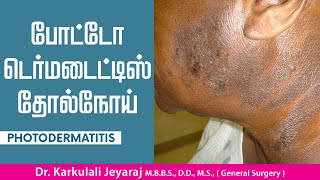 போட்டோ டெர்மடைட்டிஸ்  Photodermatitis Skin Diseases Treatment and Details  TAMIL JKT SKIN CARE [upl. by Margarita]