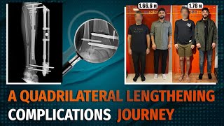 A QUADRILATERAL LENGTHENING COMPLICATIONS JOURNEY [upl. by Bax]