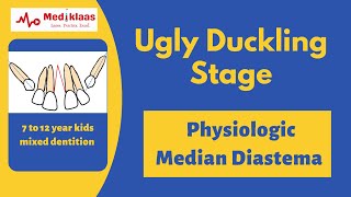 Ugly Duckling Stage l Mixed dentition l Mediklaas [upl. by Drofliw209]