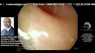 IMPACTED STOOL IN CEACUM WITH ULCERS [upl. by Vashtia]