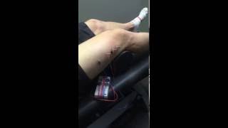 Dry Needling Quad [upl. by Mandel604]