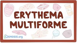 Erythema multiforme  causes symptoms diagnosis treatment pathology [upl. by Aylatan]