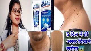 Wart Remover Ointment Honest Review2024Wart Remover ointment best usesampside effects review inhindi [upl. by Winnifred90]