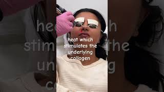 Collagen Production with Instant Glow Laser Facial ✨ laserfacial collagen laseraway [upl. by Prowel]